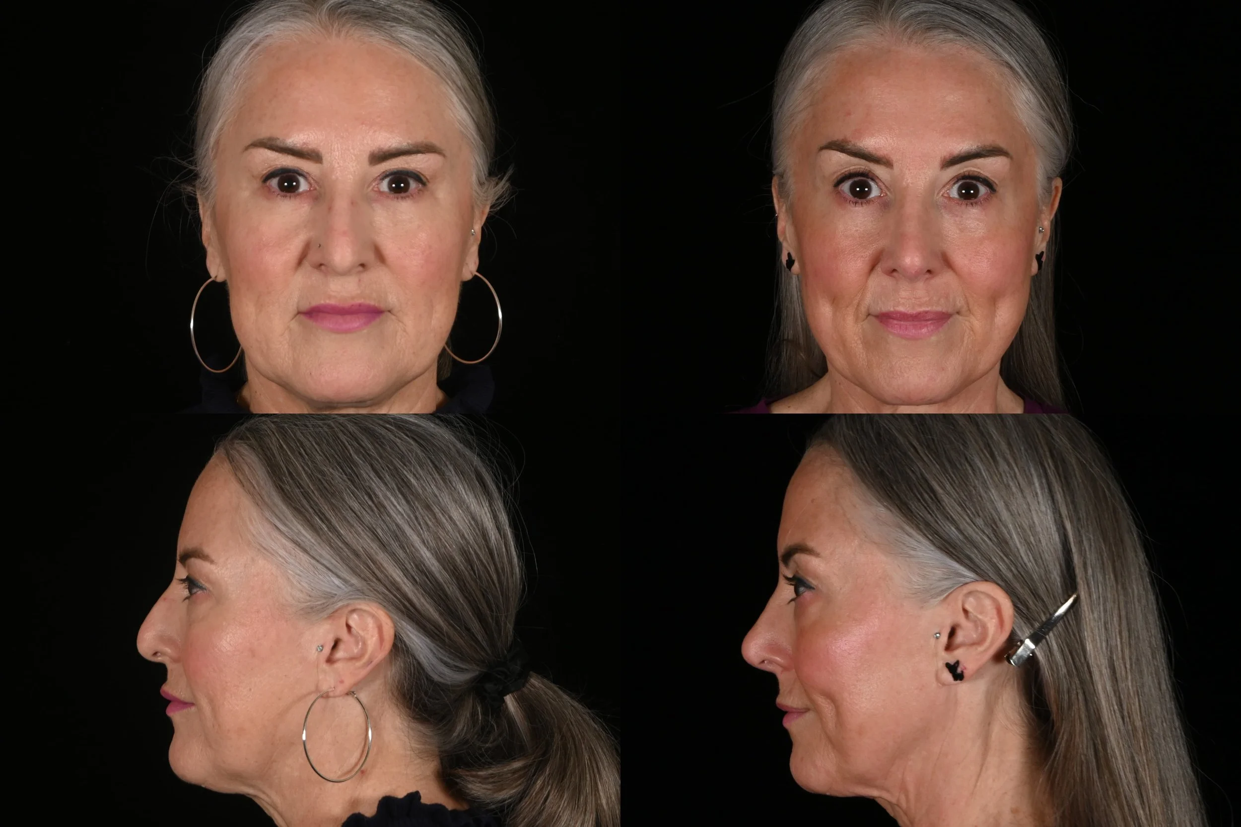 Rhinoplasty