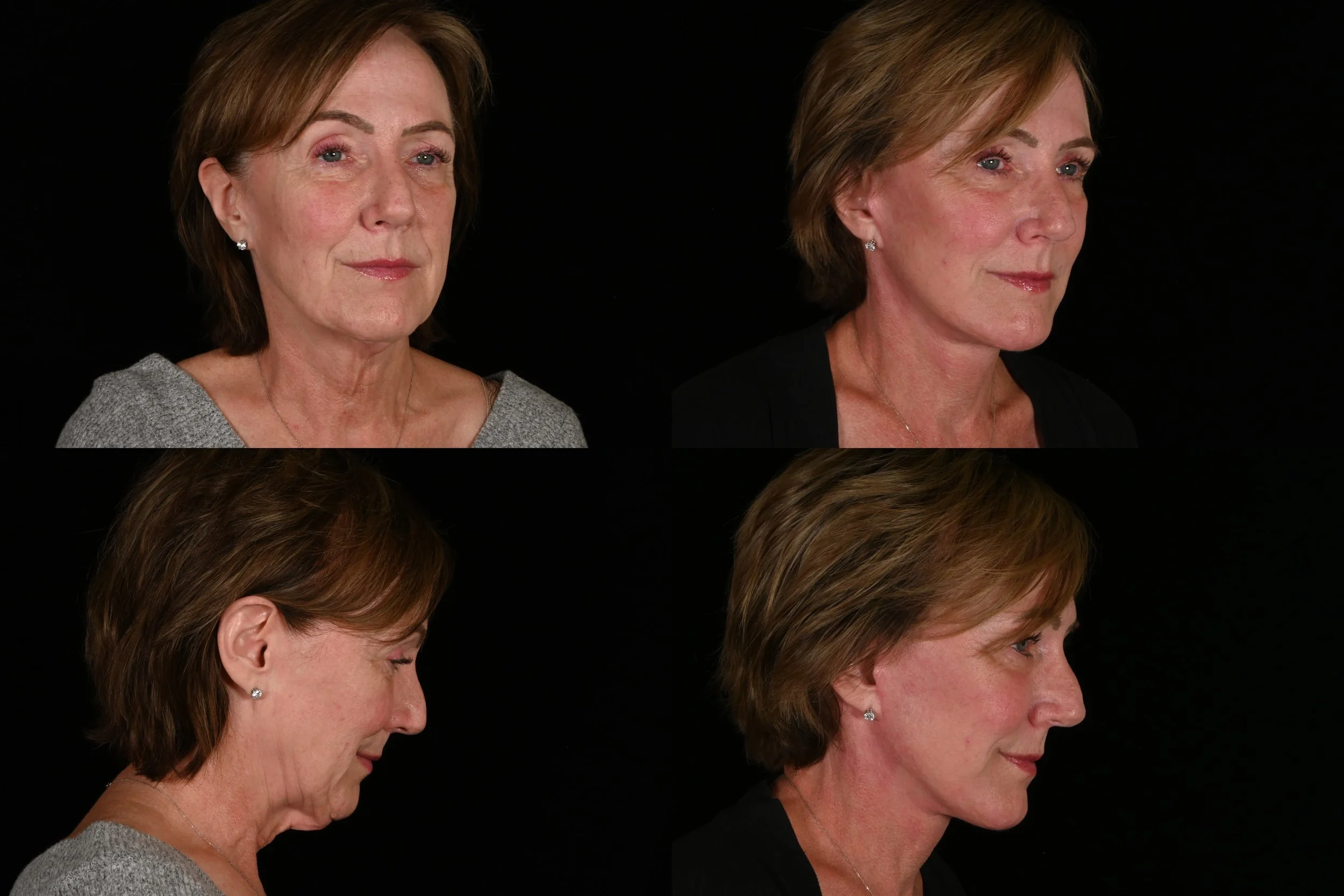 Deep plane facelift and neck lift, fat grafting, and laser resurfacing