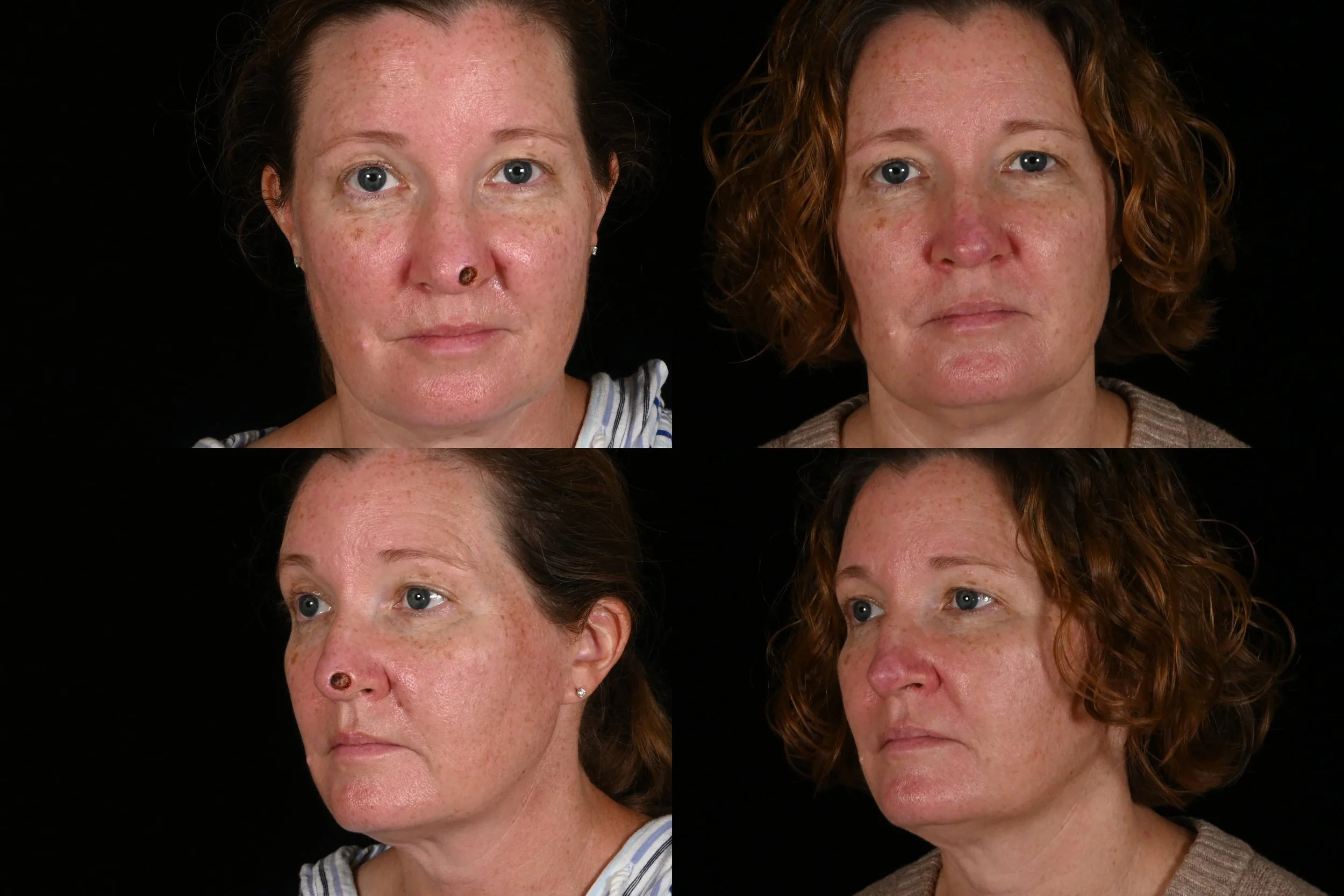 Comparison of two women before and after facial treatment, showing reduced freckles and blemishes, with different hairstyles.