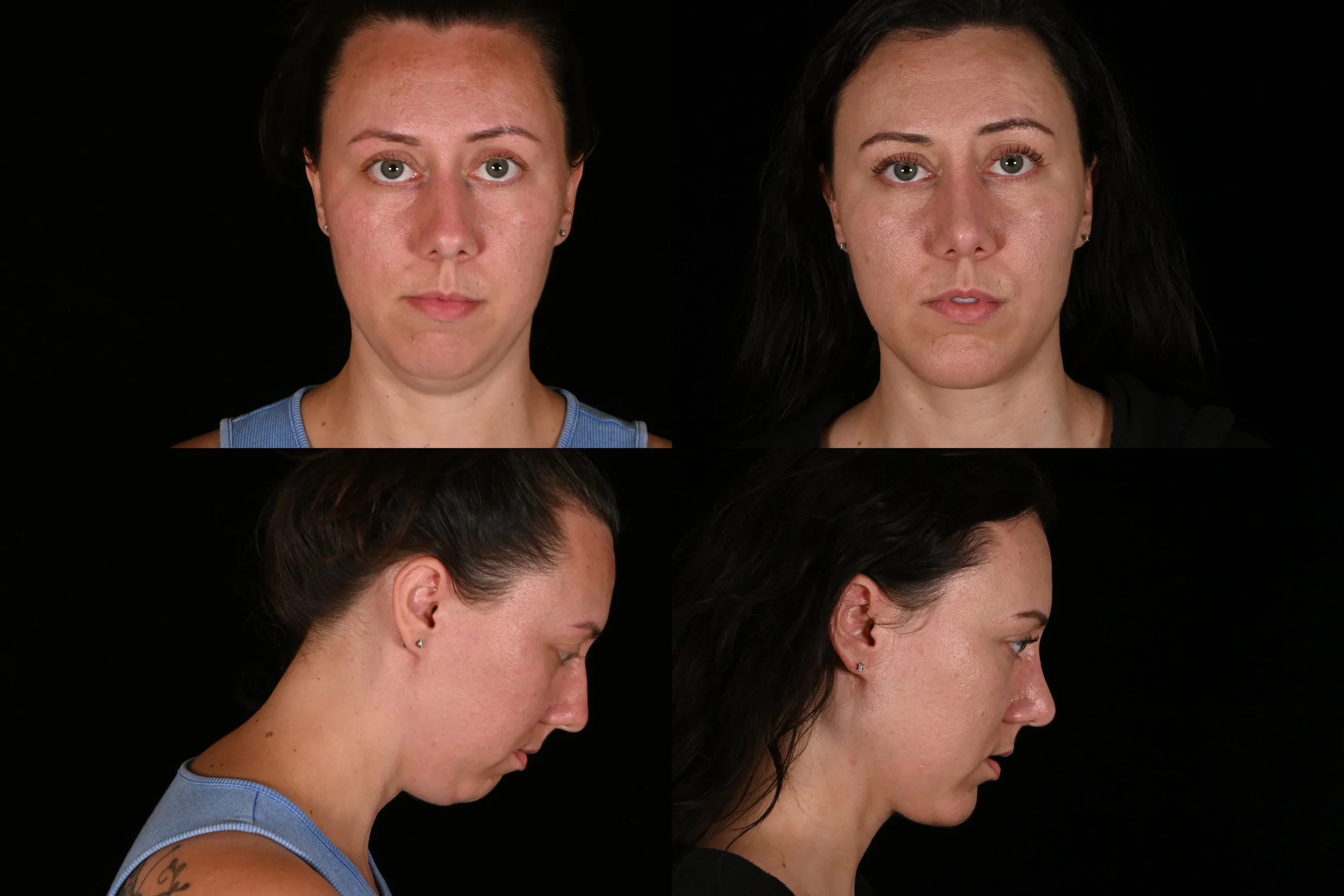 Rhinoplasty, chin implant, deep plane neck lift