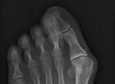 HM Edited RGB 1st MPJ Bunion.jpg