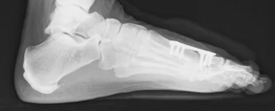 1st MPJ PO Lateral.jpg