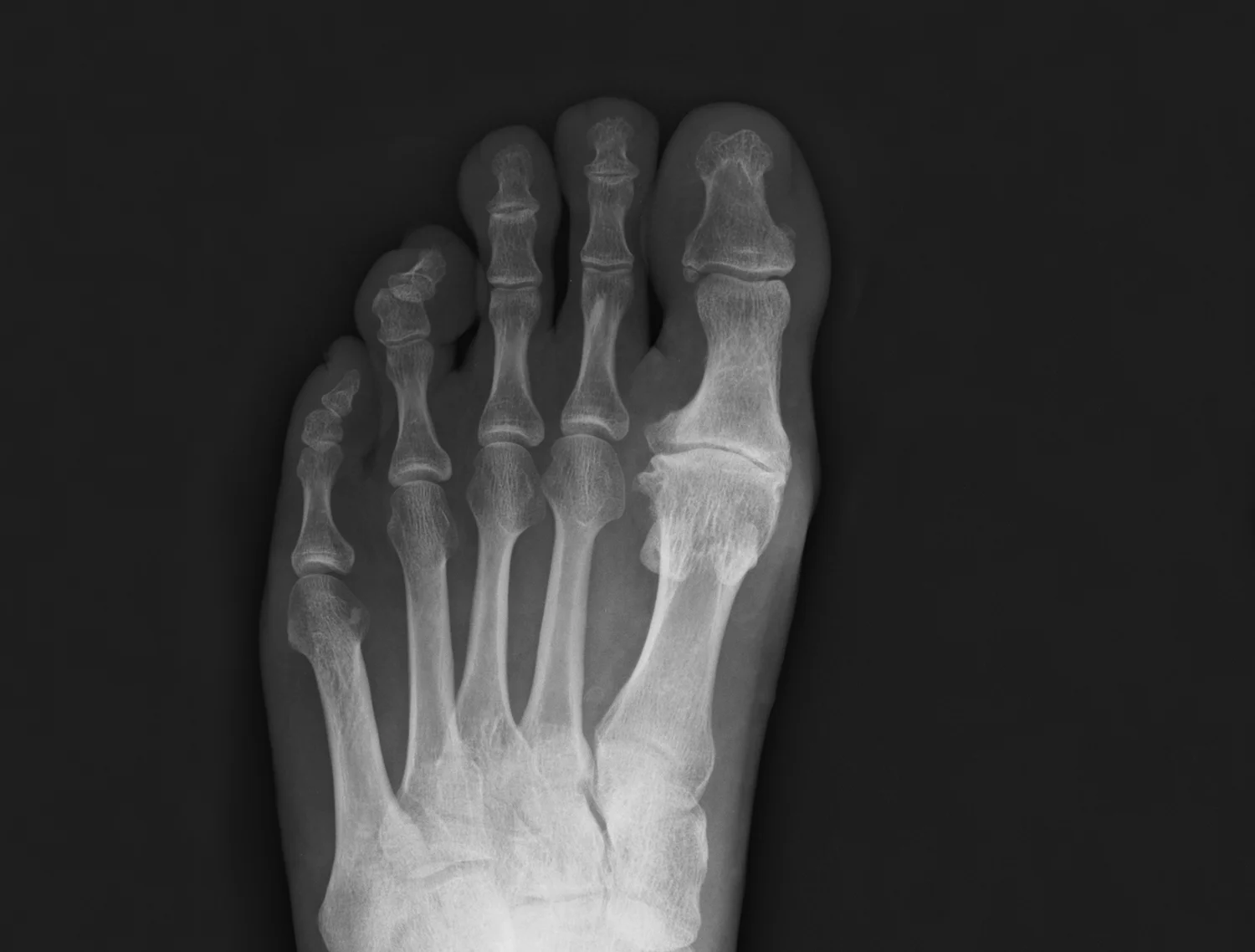 Sesamoid-Pain.jpg