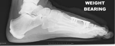 1st MPJ PO Lateral.jpg