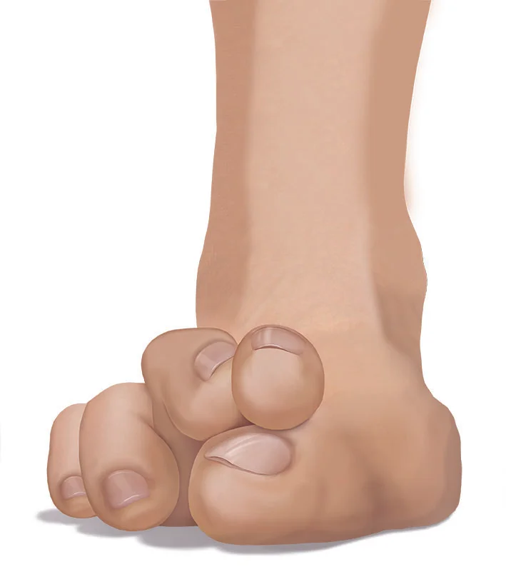 Lesser-Toe-Hammer-Claw-Mallet-Toe.jpg