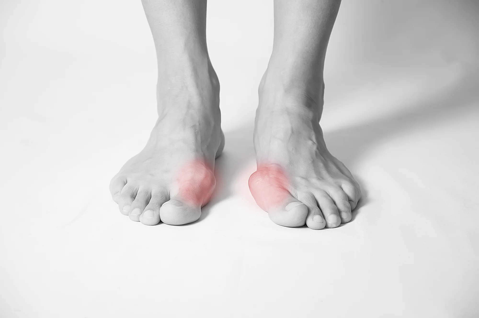 Hallux-Rigidus.jpg