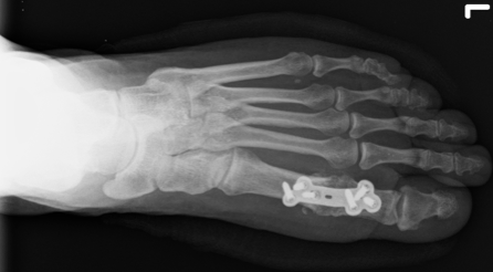 Post Op Top view.png