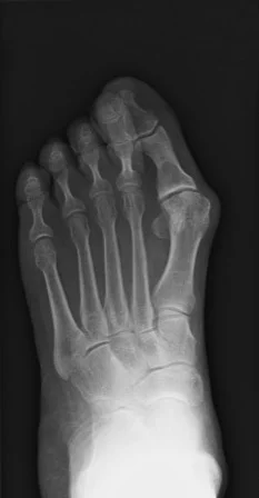 HM Edited RGB 1st MPJ Bunion.jpg