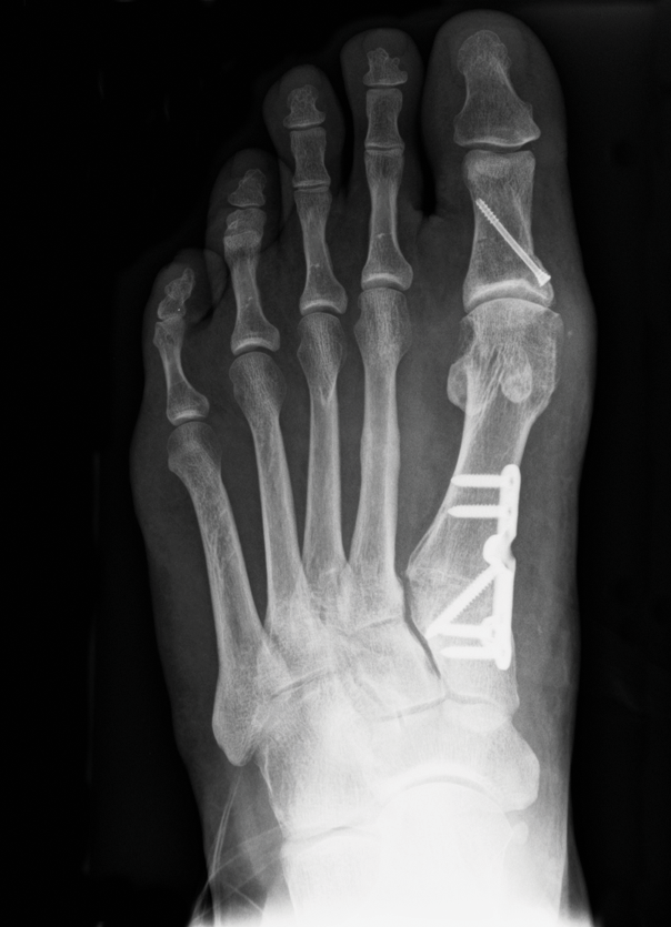 Lapidus Post Op-rgb.png