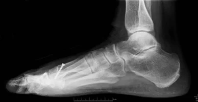 1st MPJ Chevron PO lateral.jpg