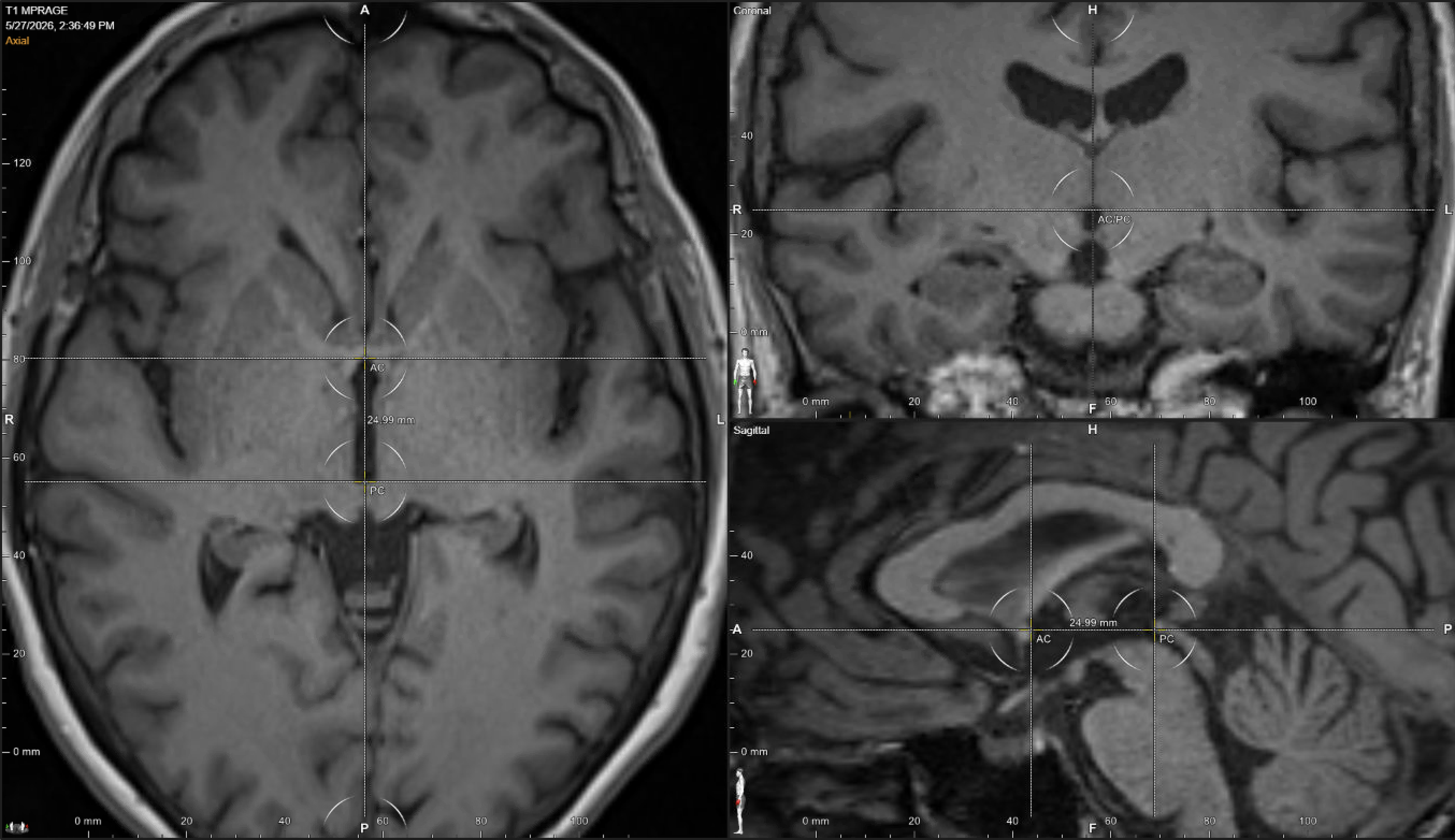 Three-panel DBS planning screenshot showing sagittal AC-PC landmark selection, axial intercommissural plane confirmation, and coronal midline alignment for stereotactic coordinate setup.