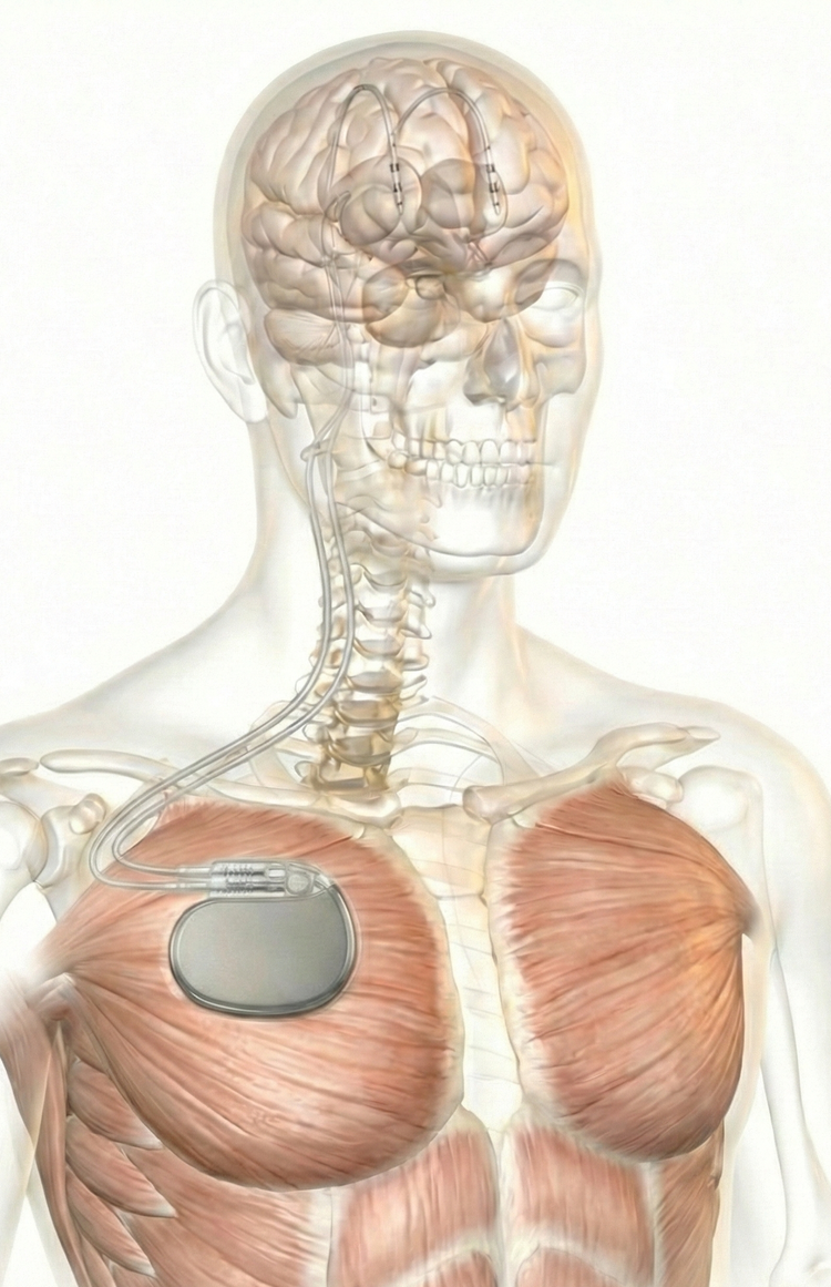 Transparent anatomical illustration of bilateral deep brain stimulation leads implanted in the brain and connected to an implanted pulse generator in the chest.