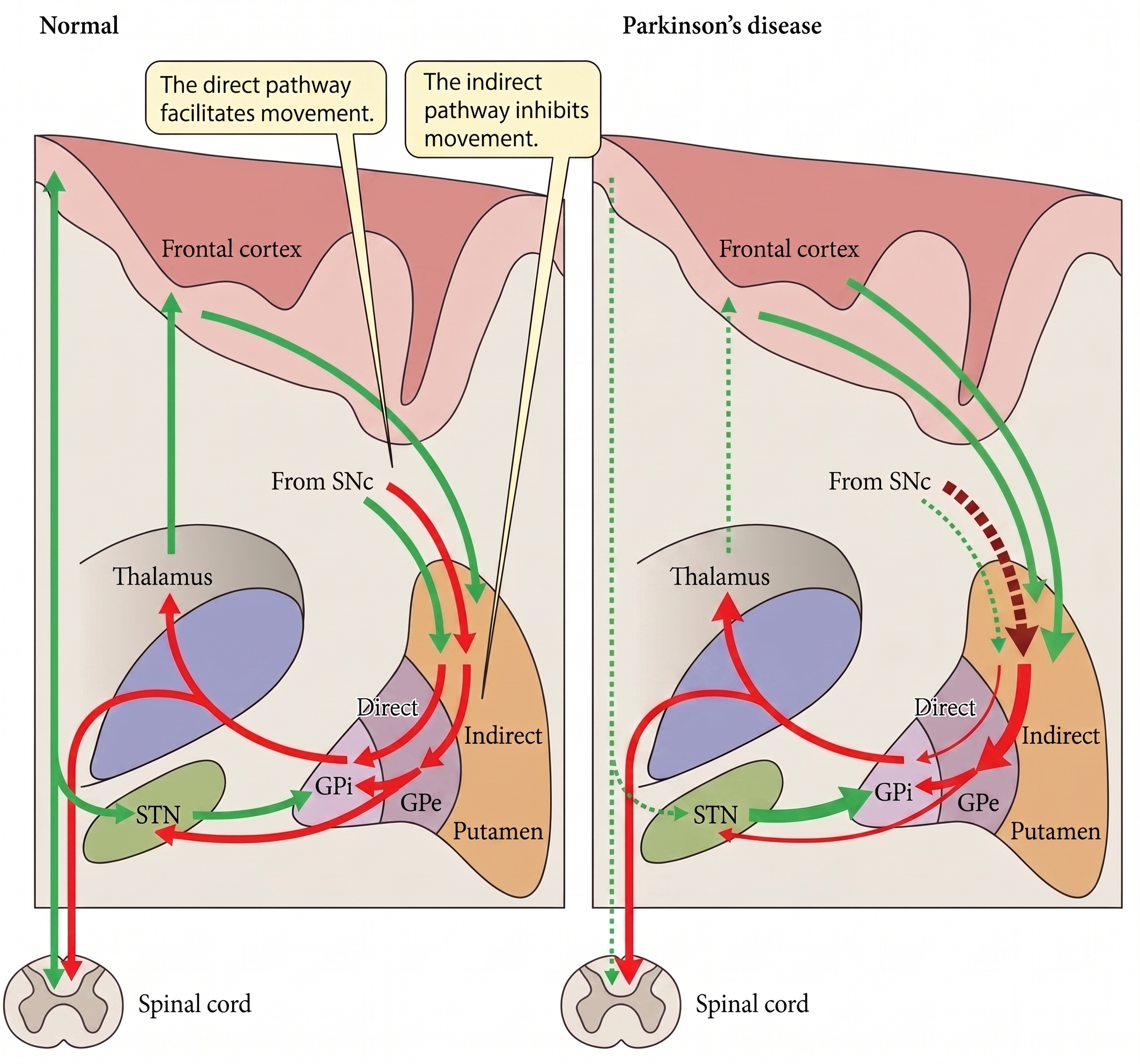 Two-panel schematic of the Albin-DeLong basal ganglia rate model comparing normal motor circuitry with Parkinson disease and showing increased STN and GPi output in the indirect pathway.