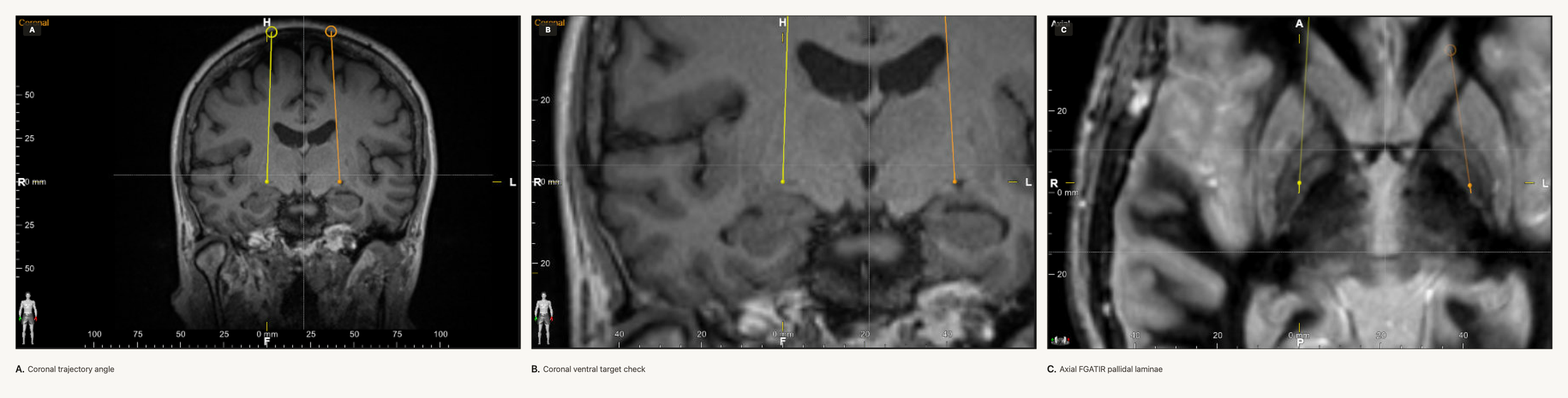 Three-panel DBS planning screenshot for GPi targeting showing coronal lead angle, close coronal ventral target position near the optic tract region, and axial FGATIR pallidal laminae with lead position.