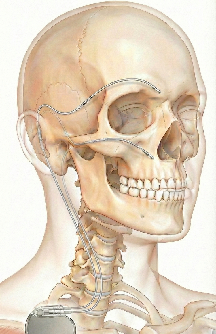 Lateral anatomical illustration showing craniofacial neuromodulation leads tunneled over the face and connected to an implanted pulse generator.