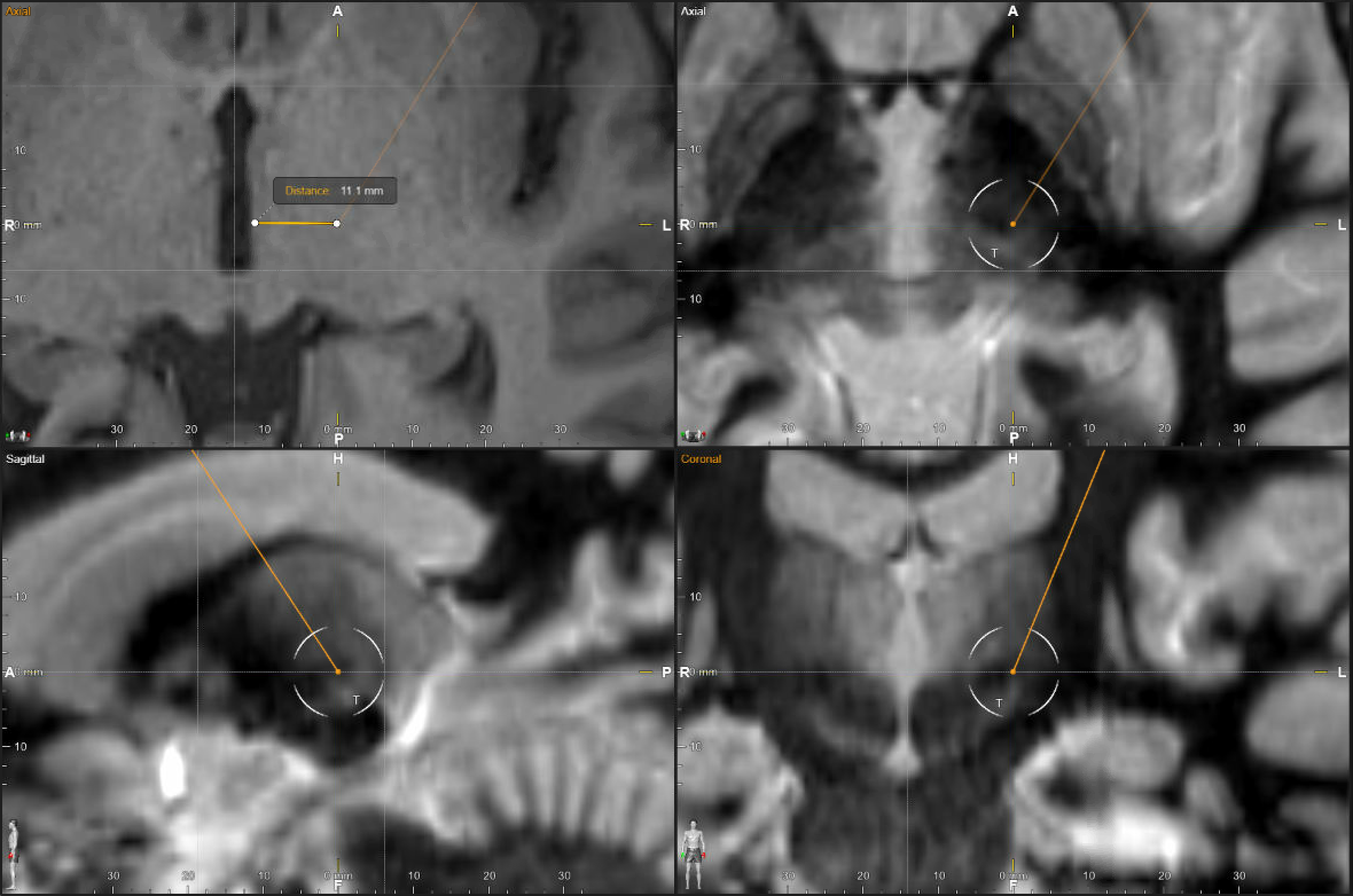 Four-panel DBS planning screenshot for Vim targeting showing axial T1 lateral-wall measurement, axial FGATIR target review, and sagittal and coronal FGATIR trajectory confirmation.