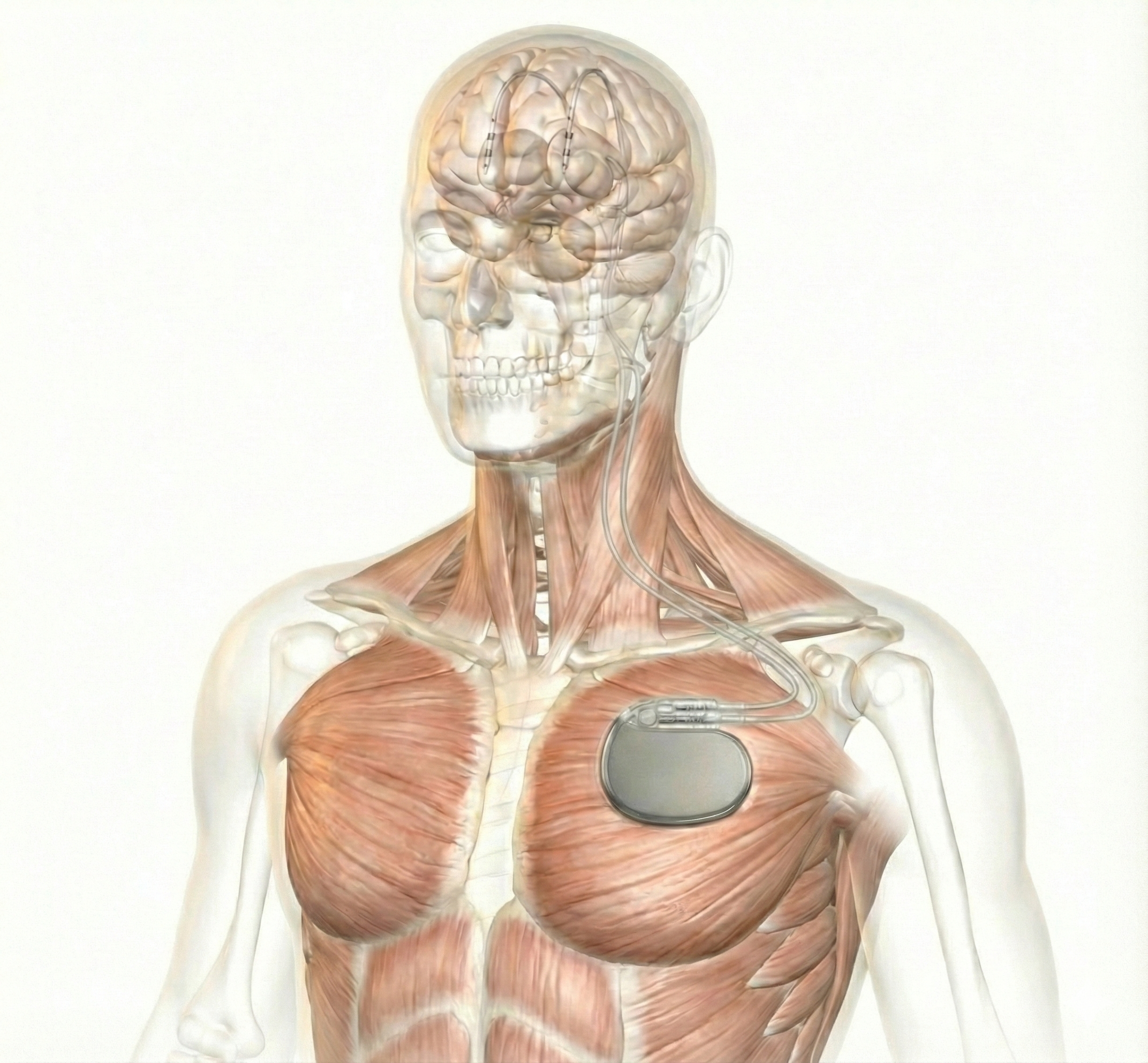 Deep brain stimulation (DBS) evaluation and treatment for Tremor and Parkinson's disease by Dr. Timoteo Almeida at UPMC.