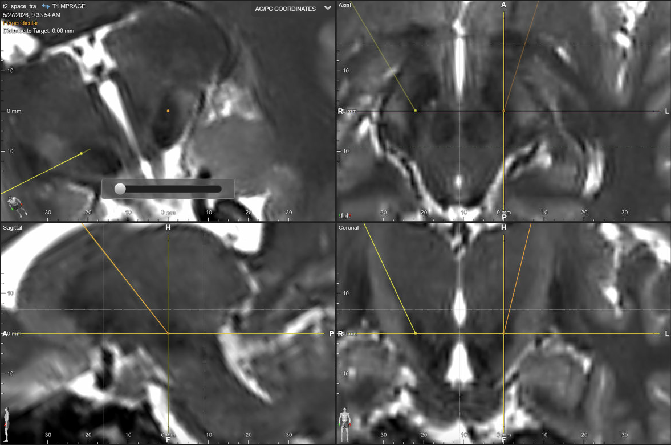 Four-panel DBS planning screenshot for STN targeting showing probe-eye, axial, sagittal, and coronal views of the planned trajectory through the subthalamic target region.