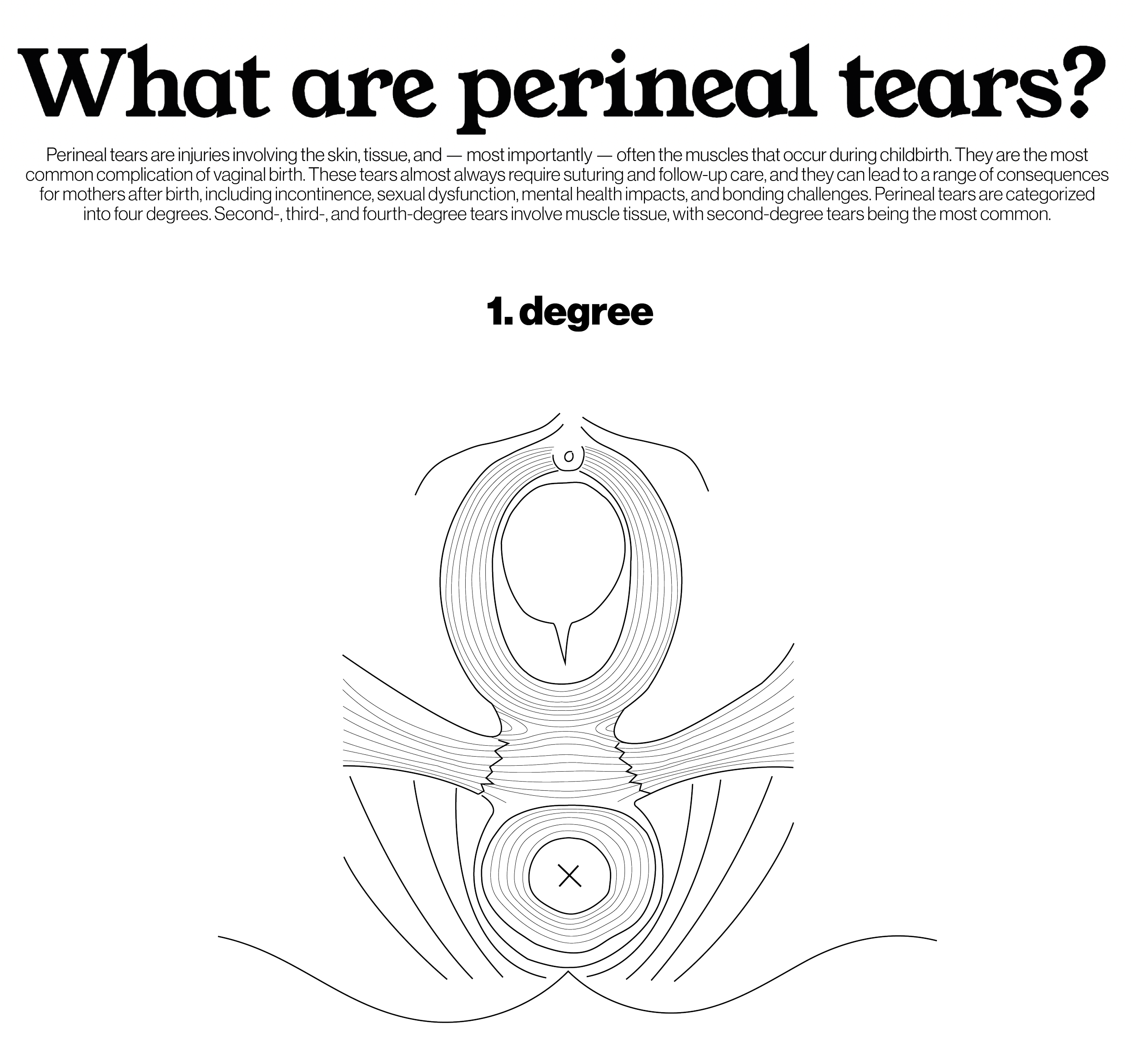 1st degree: tearing of skin and tissue, not involving muscles