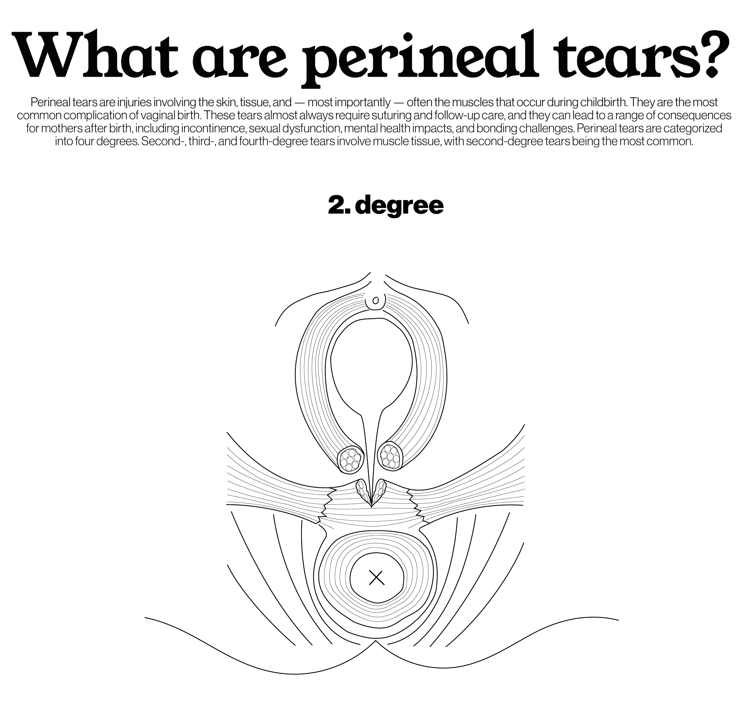2nd degree: Tearing of skin, tissue and pelvic floor muscles, most common​
