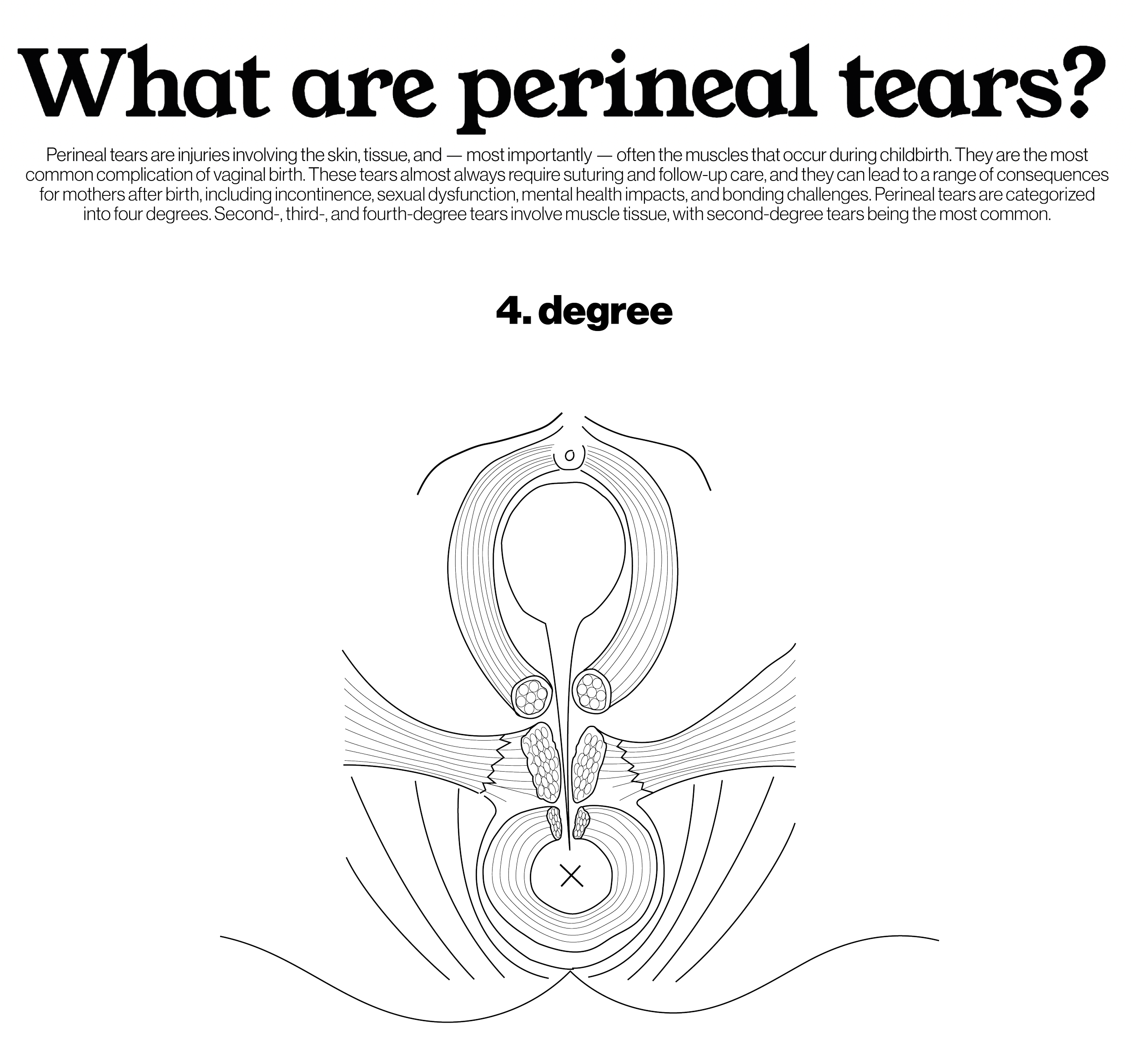 4th degree: Tearing of skin, tissue and muscles involving a full tearing of the anal spincter muscle​