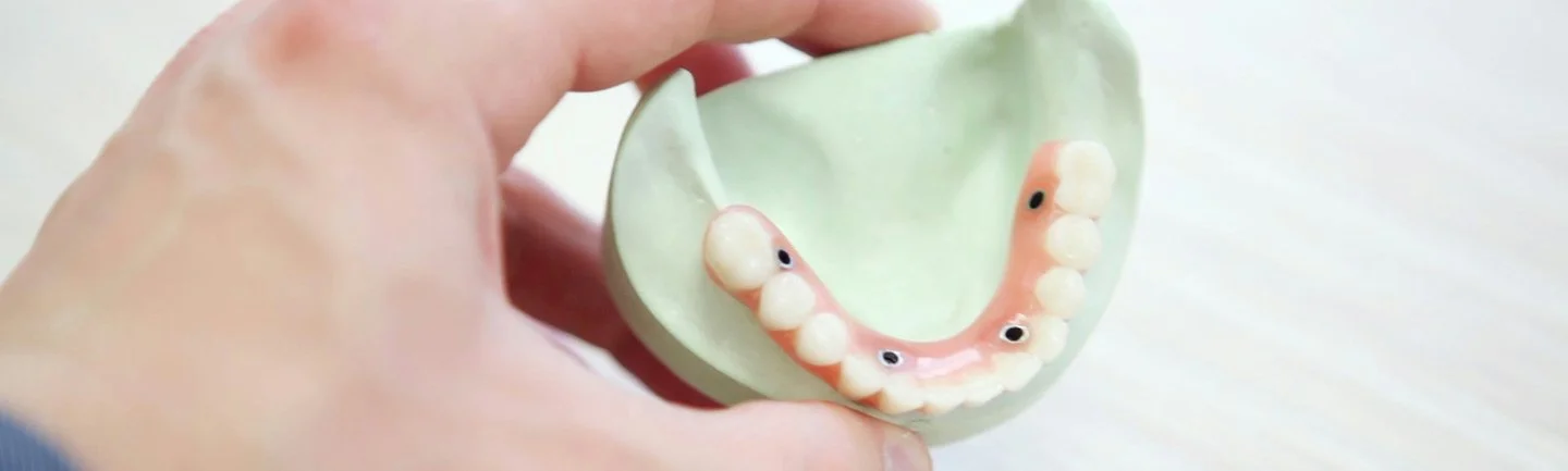 Hand hält ein Zahnmodell mit All-on-X Implantatlösung für festsitzenden Zahnersatz