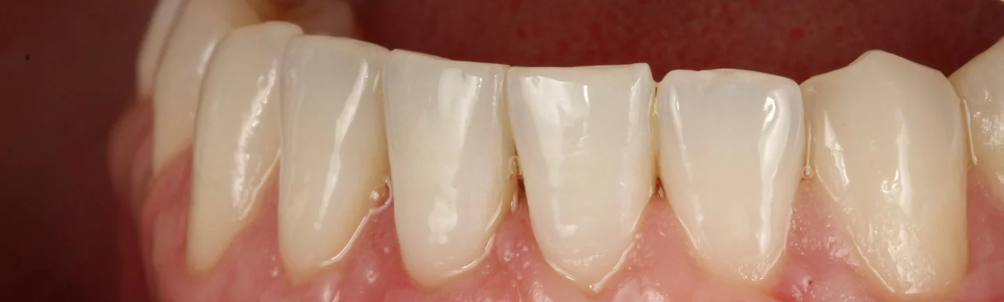 Nahaufnahme der unteren Zähne nach erfolgreicher Rezessionsdeckung mit gesundem Zahnfleischverlauf
