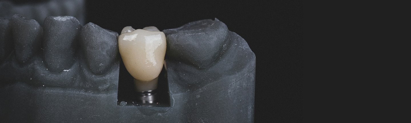 Darstellung eines Zahnimplantats im Kiefer – einzelner Zahn farblich hervorgehoben in einer grauen Zahnansicht