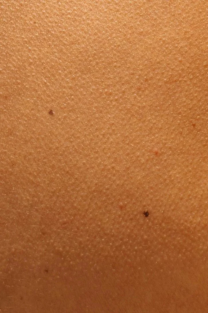 When a Skin Lesion May Be Serious