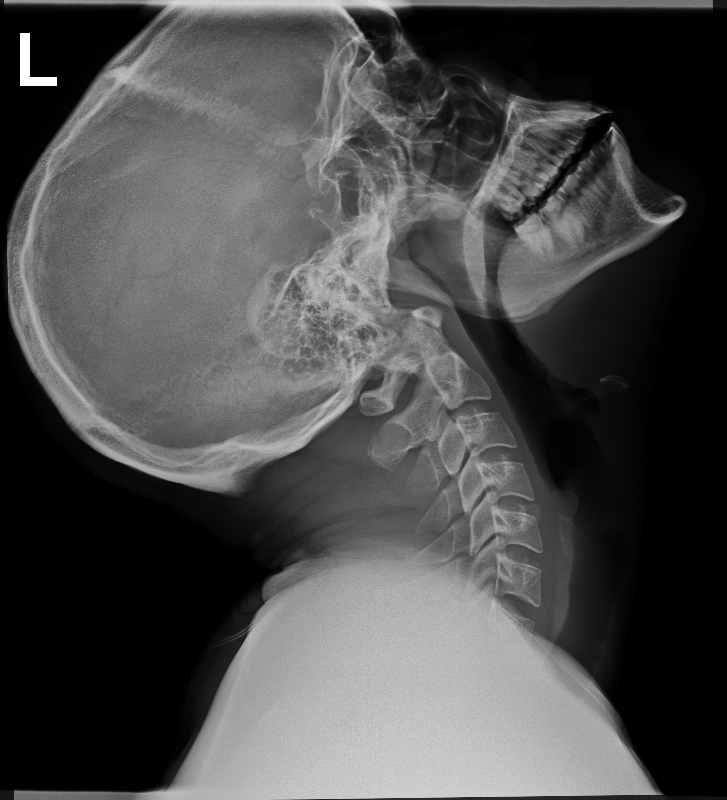 Easley Health & Spine Car Accident