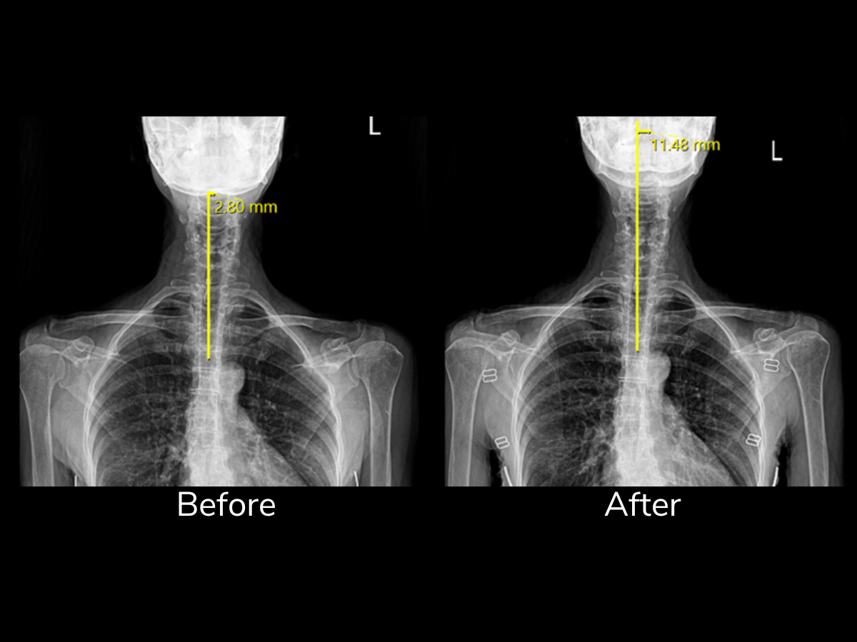 X-ray images of a human neck and upper chest, showing a before and after comparison. The before image has a measurement of 2.80 mm, and the after image has a measurement of 11.48 mm, indicating an increase in the space or structure.