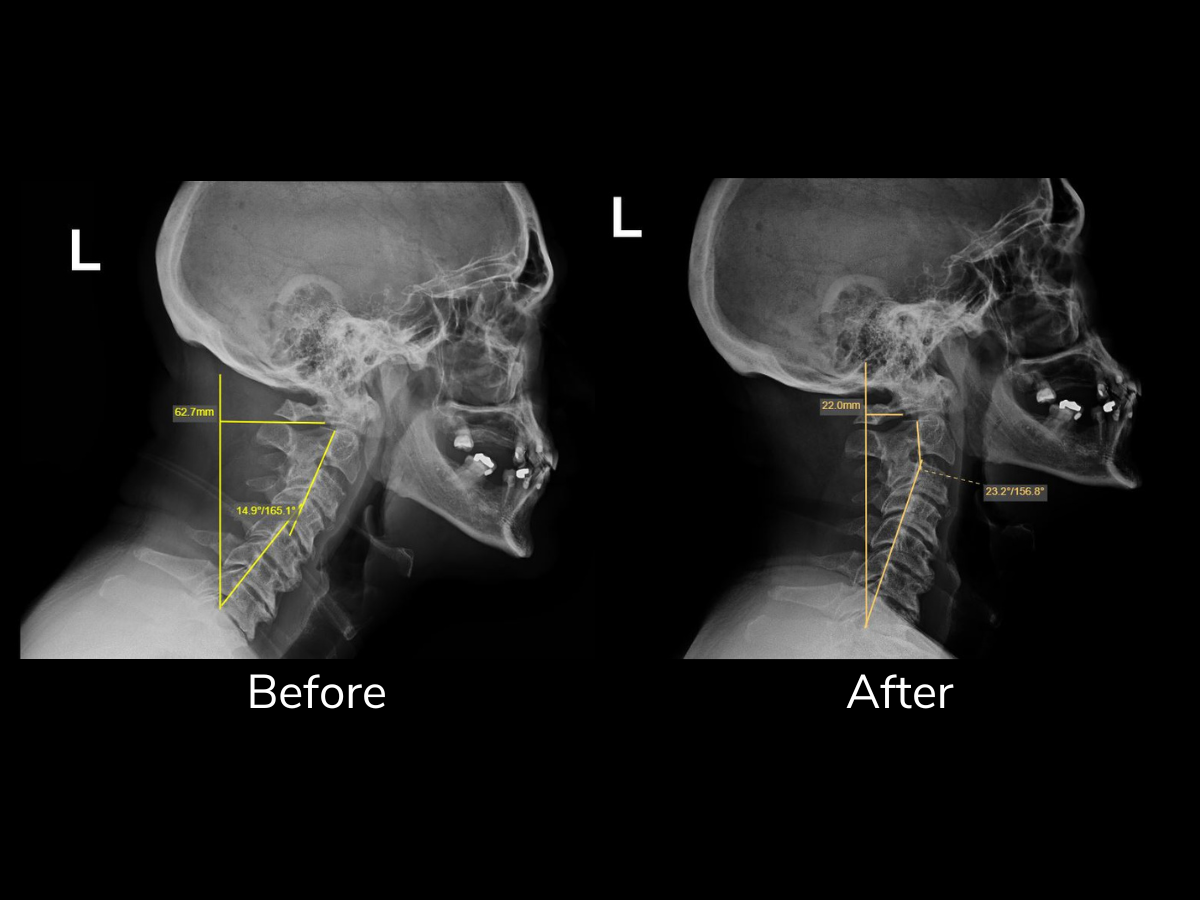 X-ray images of a person's head and neck showing measurements before and after a medical procedure or treatment.