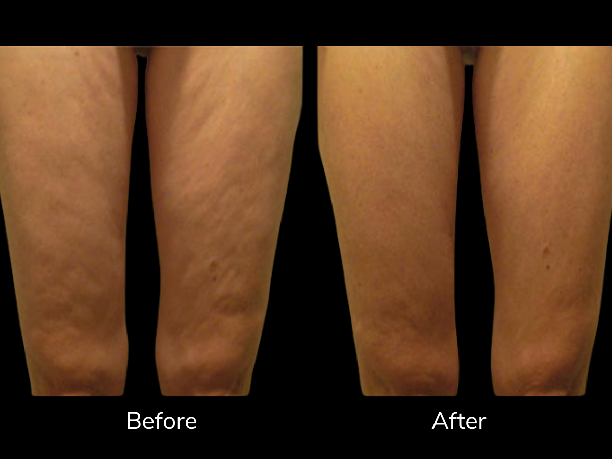 Comparison of legs showing skin improvement; before and after treatment for skin texture and appearance.