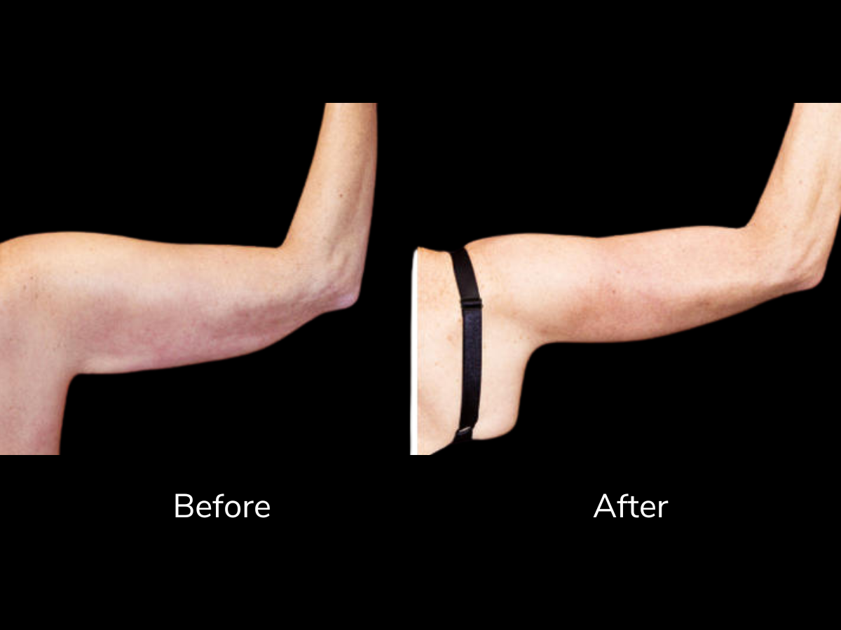 Side-by-side comparison of a person's arm before and after skincare or treatment, with the before arm showing loose, sagging skin and the after arm showing tightened, more toned skin, demonstrating improvement.