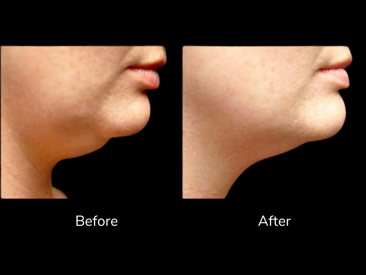 Comparison of a woman's chin and jawline before and after skin treatment, showing reduction in skin sagging and improved skin smoothness.