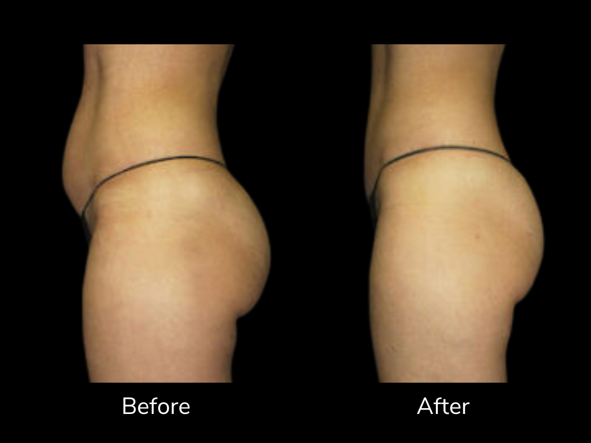 Comparison of a person's buttocks showing a before and after change, with the 'before' on the left and 'after' on the right, against a black background.