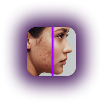 Side-by-side comparison of a woman's face showing acne scars on one side and clear skin on the other.