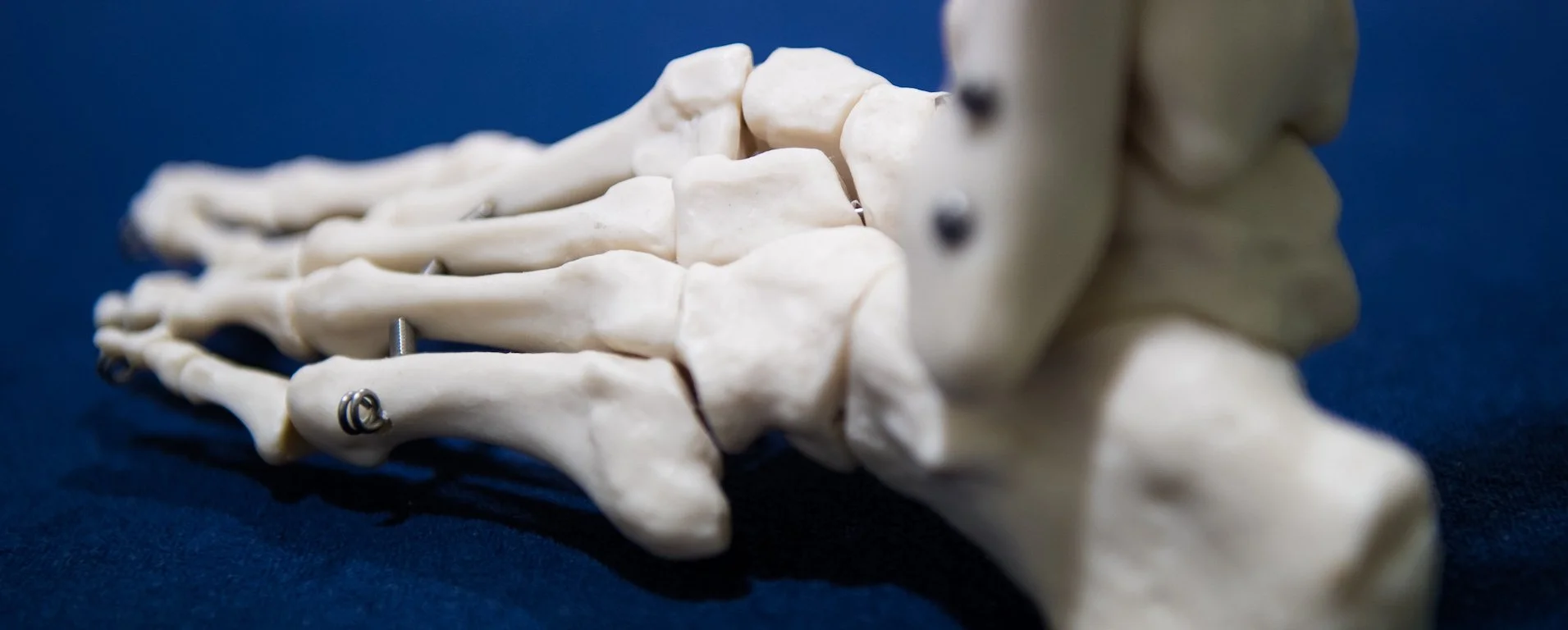 Evolve Osteopathy Plantar Fasciitis York & Selby