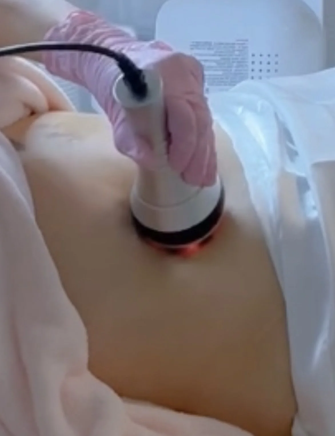 Radiofrequency & Cavitation