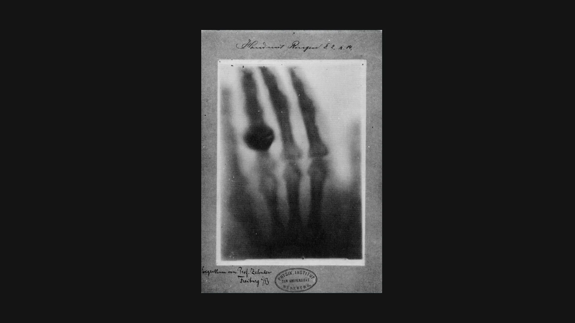 Röntgen 1895: X-ray of a human hand revealing bones and wedding ring – first medical radiograph