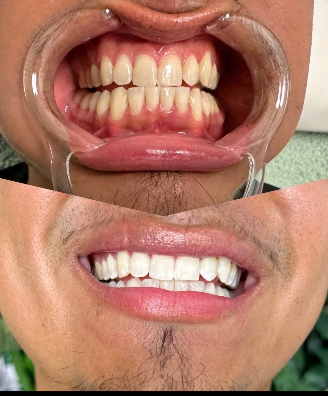 Silver Hybrid Whitening