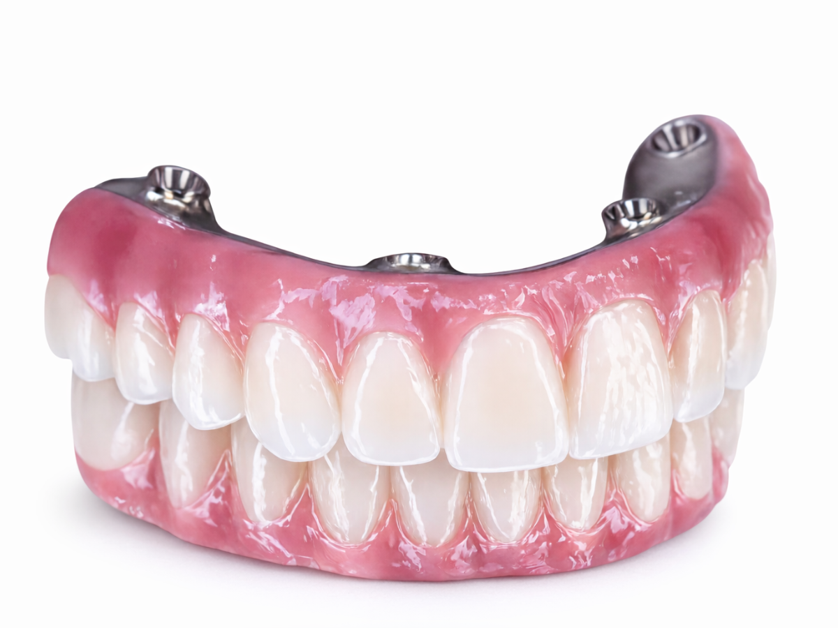 All-on-4 full arch dental implants in Mexico City