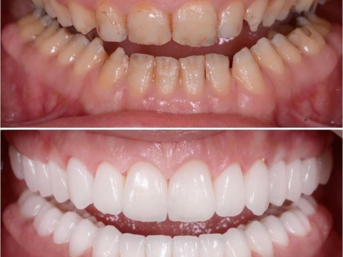 Full mouth rehabilitation treatment in Mexico City