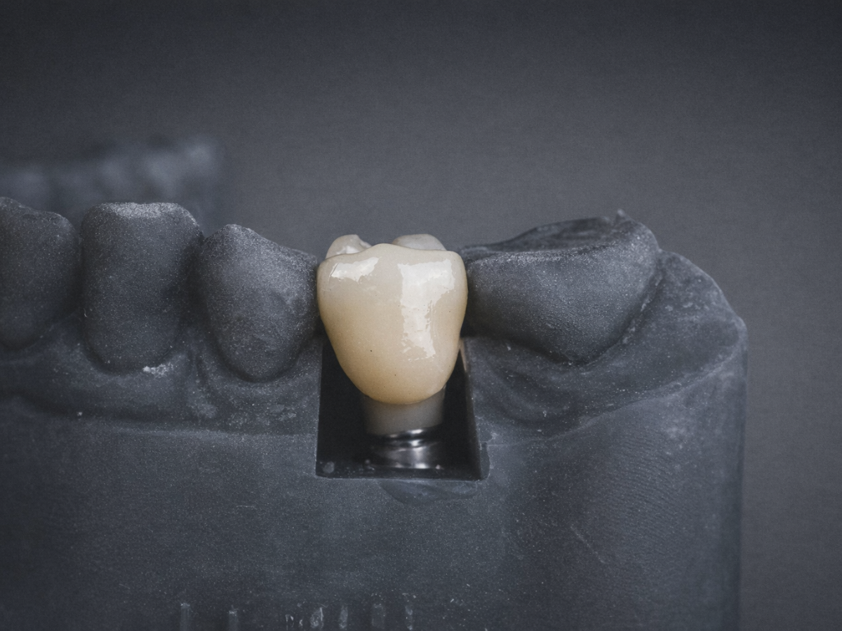 Advanced dental implant treatment in Mexico City