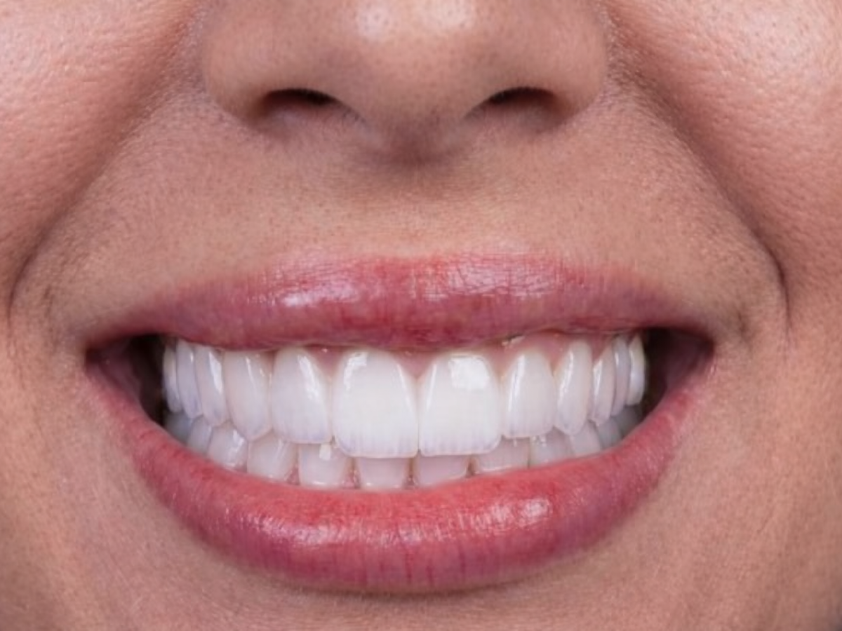 Hollywood smile veneers transformation in Mexico City