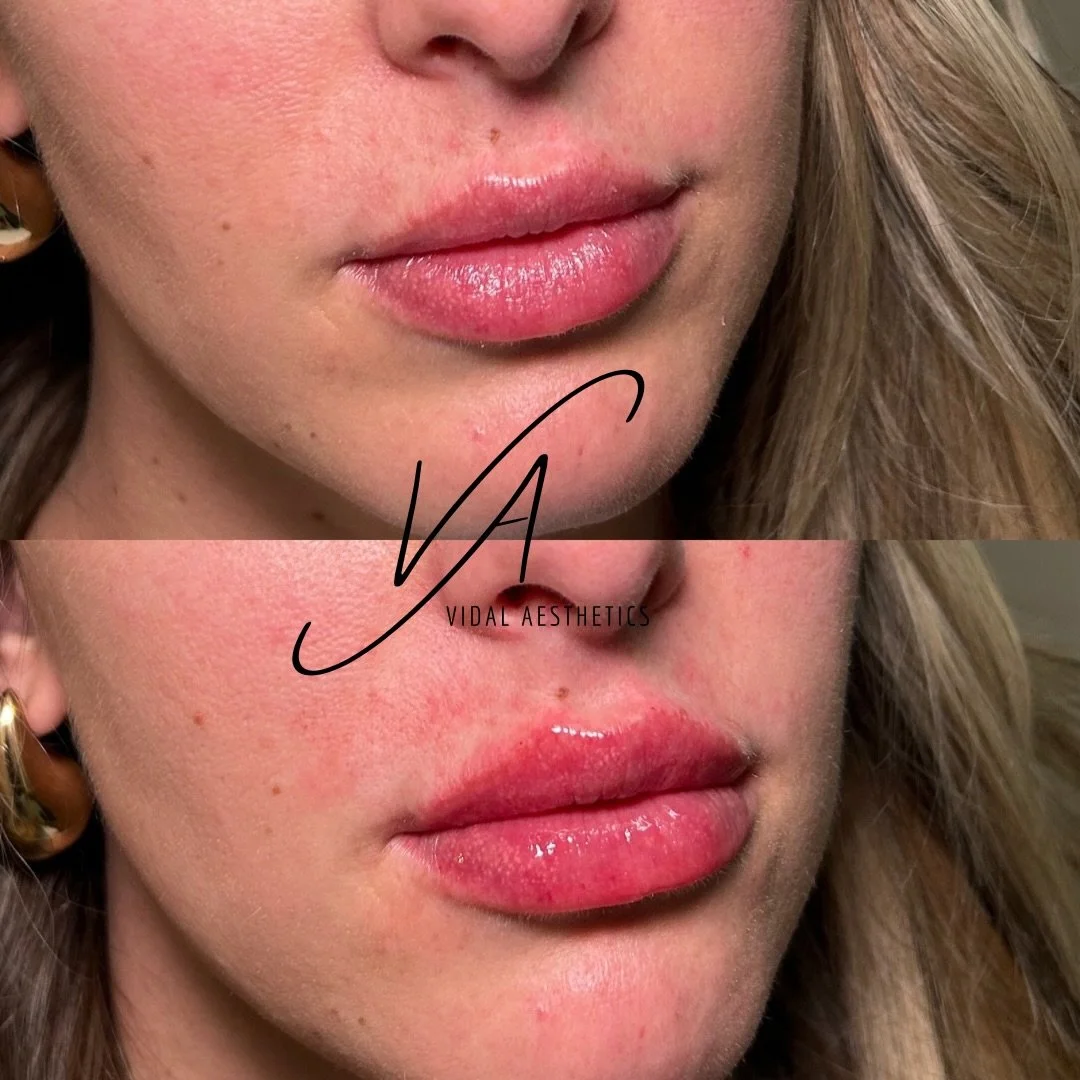 Soft, balanced, and beautifully tailored to you. 💋
Our Valentine&rsquo;s Lip Special is here:
Full Lip: $527
Mini Lip: $307
Personalized techniques, natural-looking results, and just the right amount of enhancement for your goals.
Limited-time offer