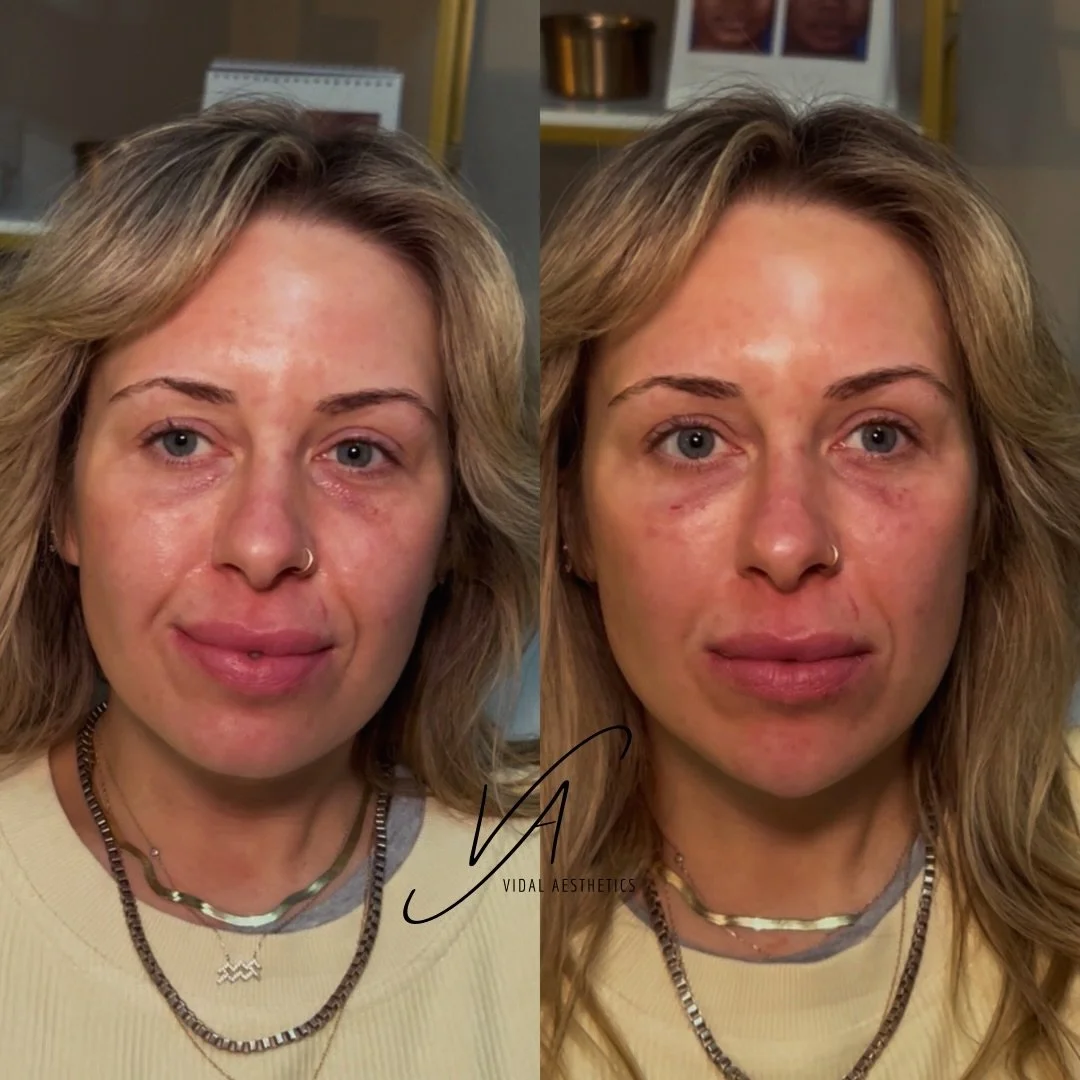 If we told you this was just one syringe would you believe it?? 

Radiesse is our powerhouse. Combining structural support with bio stimulation that will compound over the next 18 months! 

Make sure your injector is using more than just &ldquo;fille