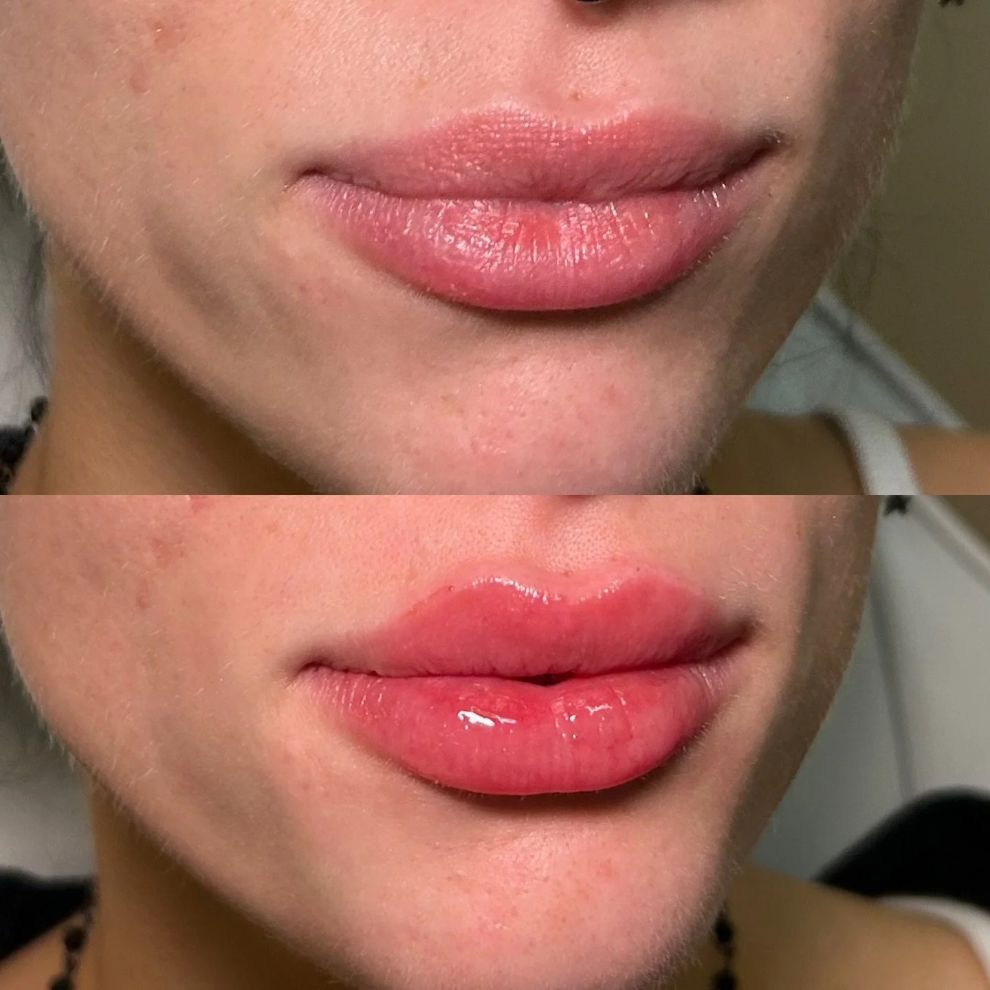 If you&rsquo;ve been overlining your lips&hellip; it might be time. 💉✨
Balanced, hydrated, perfectly shaped &mdash; results that still look like you, just elevated.

#lipfiller #filler #medspalife #lipglosspoppin