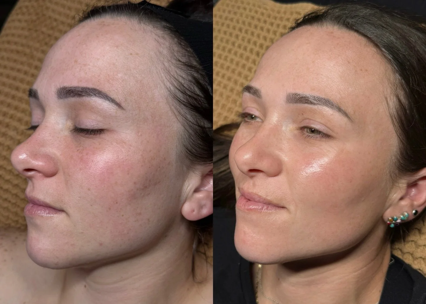 Consistency always wins. ✨

Great skin isn&rsquo;t created in one appointment &mdash; it&rsquo;s built through consistent homecare and strategic treatments over time.

Our Aesthetician Sara achieved these results using:
&bull; microneedling
&bull; la