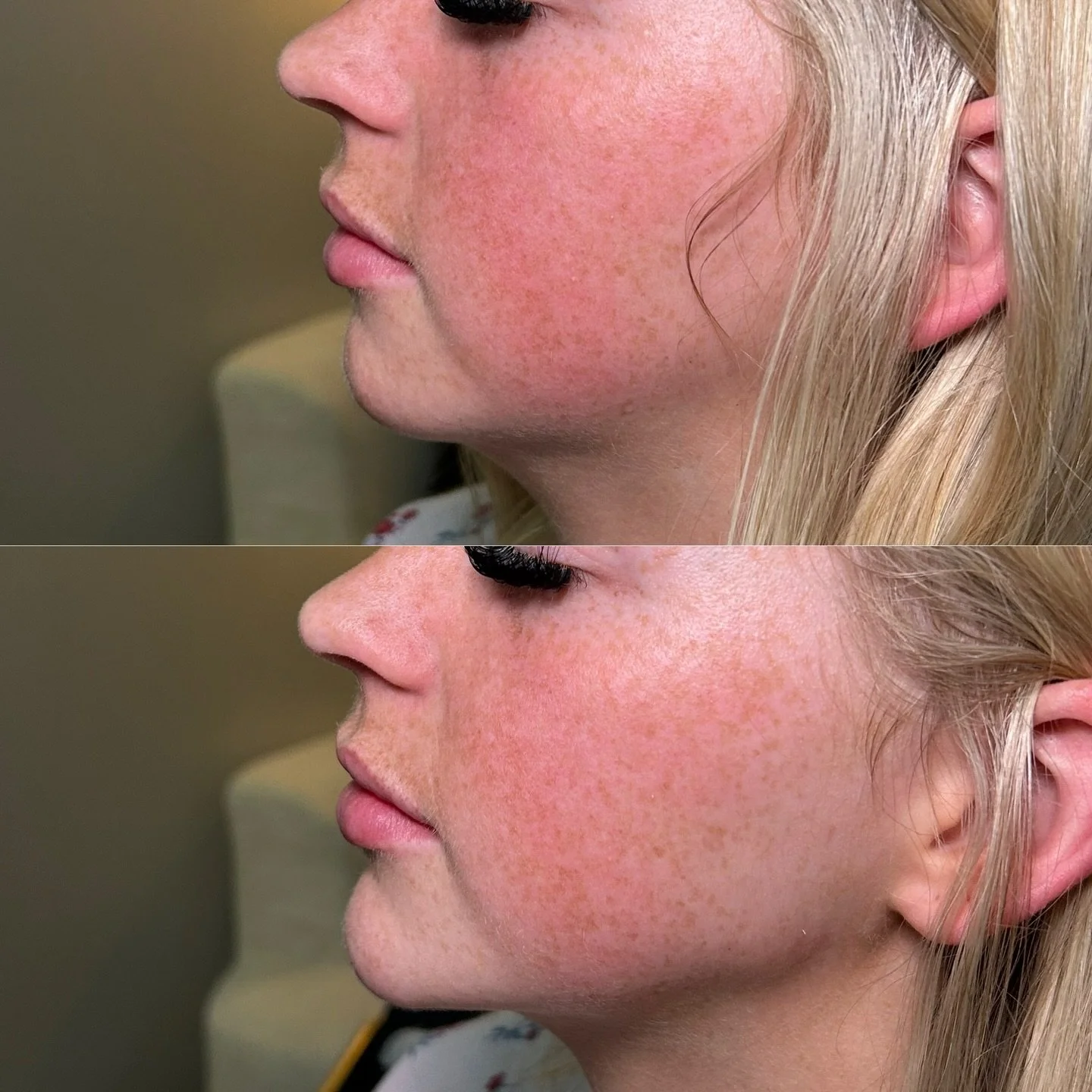 Chin filler can completely change the balance of your face &mdash; without changing you. 🤍

A little added projection + definition can:
✨ sharpen the jawline
✨ improve side profile
✨ create a more balanced lower face
✨ give that subtle &ldquo;snatch